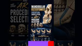 Mandibular Osteotomies: Evolution and Procedure Selection