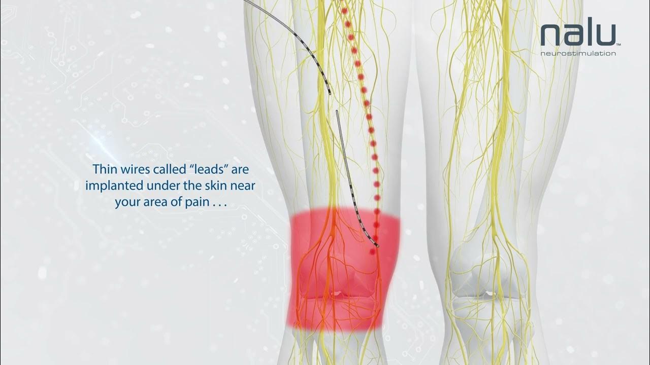 Peripheral nerve stimulator video youtube