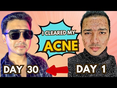My Acne Journey | 1 Month Pimple Cure | I Cleared My Acne Only In 30 ...