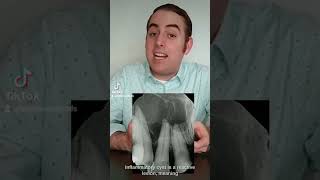 Commonly confused: inflammatory vs dentigerous cyst. Do you know the difference? #youtubeshorts screenshot 3