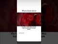 blood cancer process in human ♈♈#nssir #new #neet #study #motivation ☠️☠️☠️☠️☠️☠️☠️