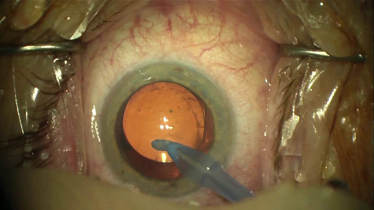 Bilateral cataract surgery with bluelight filtered IOL