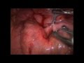 Laparoscopic repair of internal hernia after RYGB, Jonathan Carter MD, UCSF