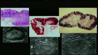Ultrasound Evaluation of Regional Lymph Nodes.