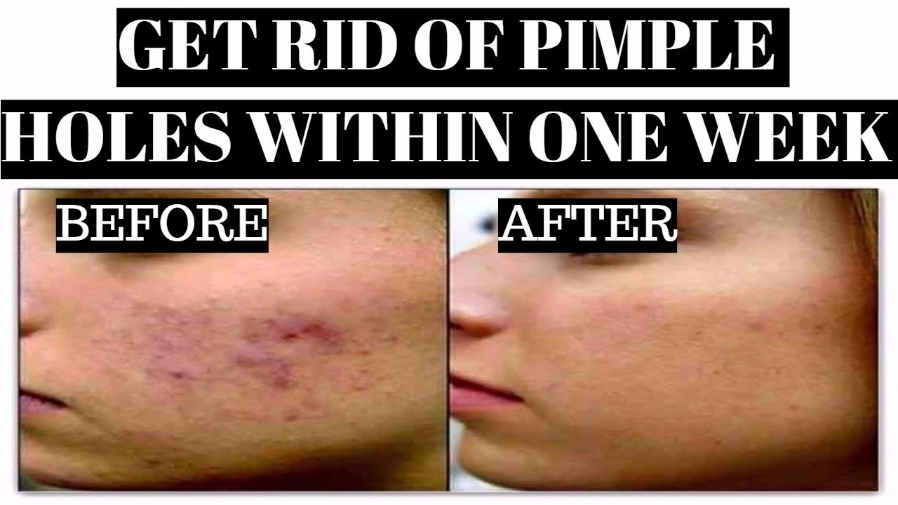 Pimple Holes & Marks Will Disappear Within 1week I Beauty Cuts YouTube
