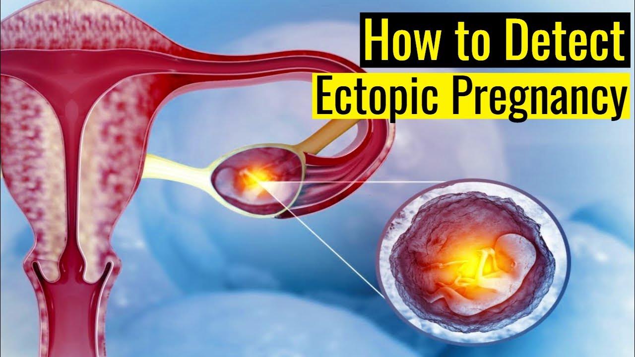 How Soon Can A Blood Test Detect Ectopic Pregnancy