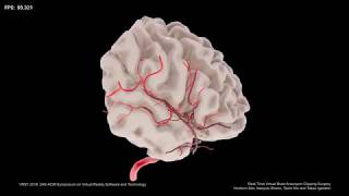 VRST 2018 Demo: Real-Time Virtual Brain Aneurysm Clipping Surgery
