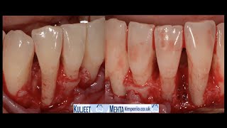 Periodontal Surgery with PRF by Dr Kuljeet Singh Mehta-Periodontist 11,317 views 1 year ago 19 minutes