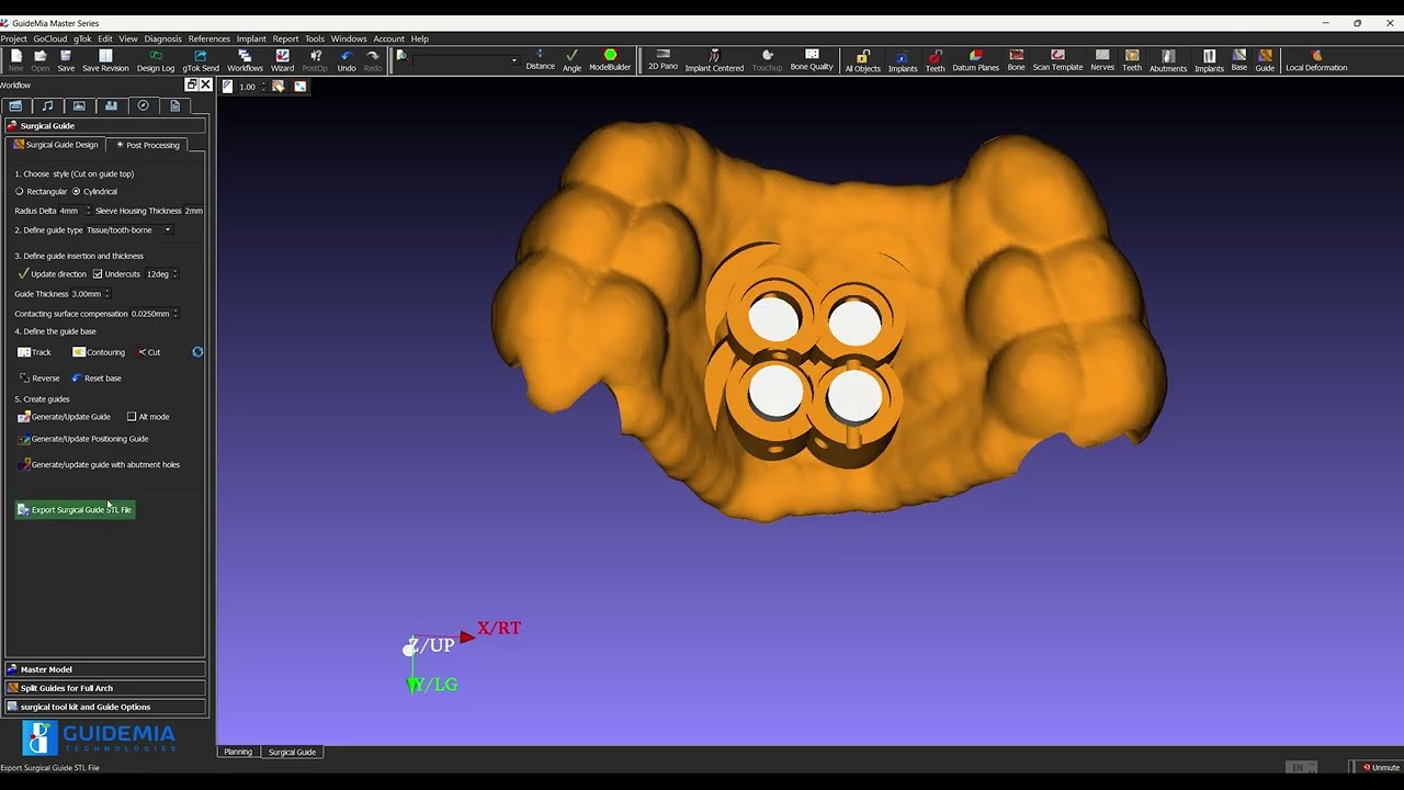 Minitad design with GuideMia Master Version