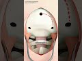 Craniectomy Brain Surgery 3D Animation#braintumorawarness #braintumorsurvivor #braintumorsurgery