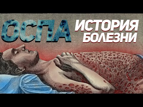 ЧЕРНАЯ ОСПА | УЖАСНАЯ БОЛЕЗНЬ УБИВШАЯ МИЛЛИОНЫ ЛЮДЕЙ | ИСТОРИЯ БОЛЕЗНИ