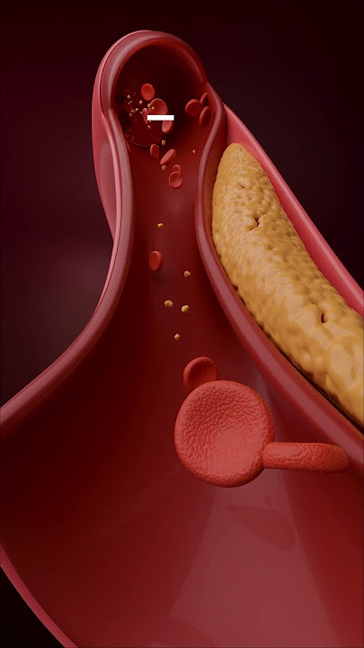 किस तरह आता है हार्ट अटैक ?How Does a Heart Attack Happen? Step-by-Step Explanation!