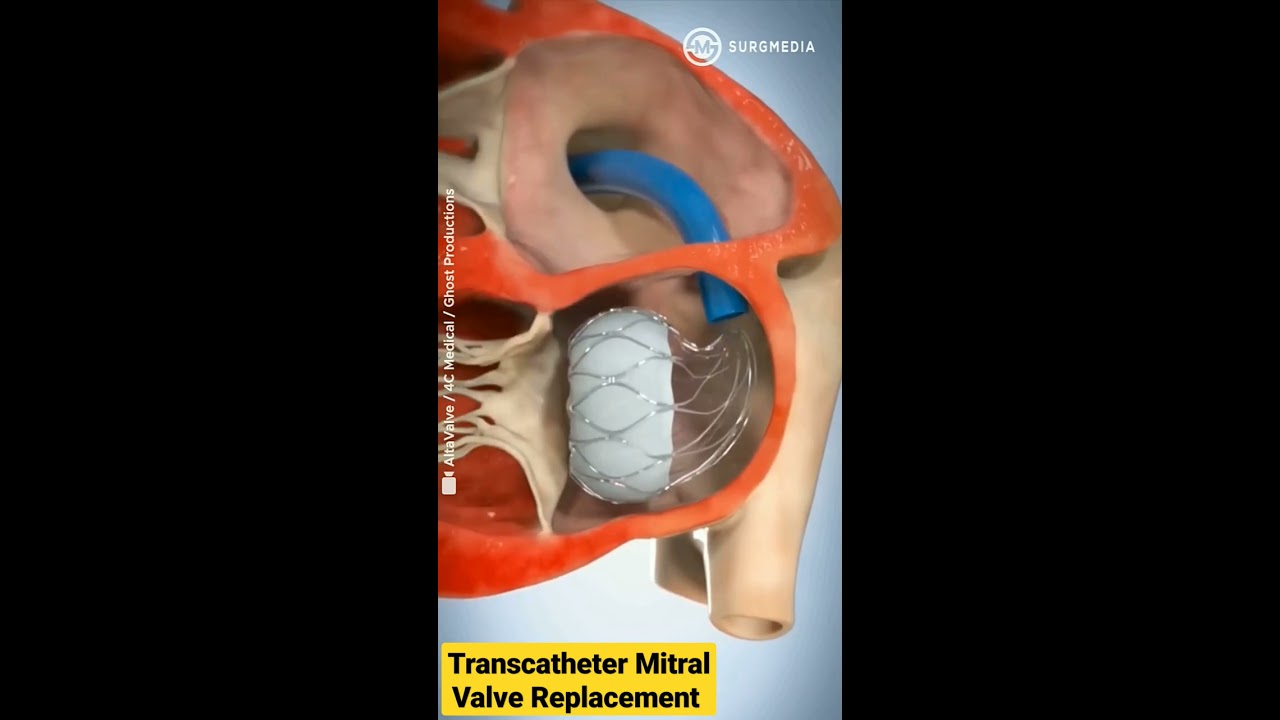 Altavalve Transcatheter Mitral Valve Replacement TMVR  shorts  medical  animation