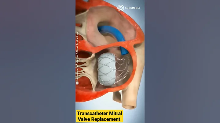 Altavalve: Transcatheter Mitral Valve Replacement (TMVR) #shorts #medical #animation - DayDayNews