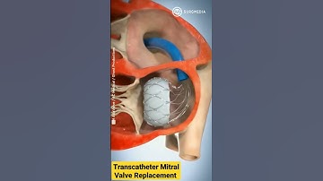 Altavalve: Transcatheter Mitral Valve Replacement (TMVR) #shorts #medical #animation
