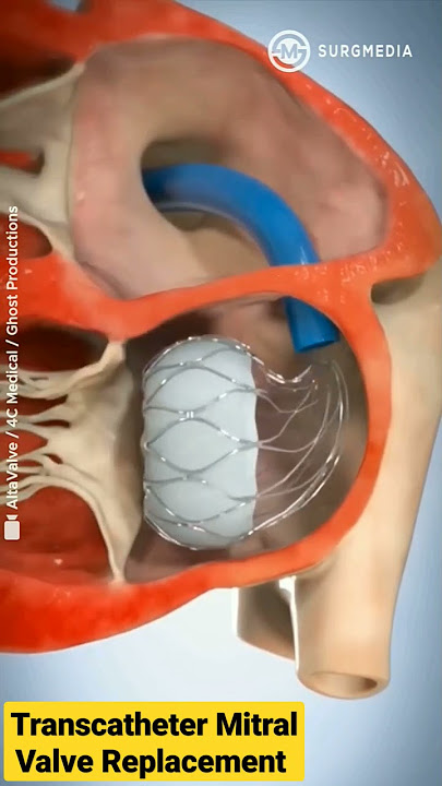 Altavalve: Transcatheter Mitral Valve Replacement (TMVR) #shorts #medical #animation