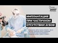 Имплантация при частичном отсутствии зубов