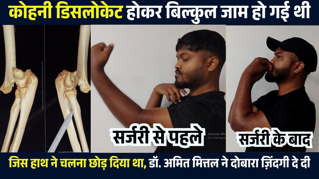 जाम कोहनी से परेशान मरीज को मिला सहारा, डॉ. अमित मित्तल ने फिर से... | Elbow Jaamed Treatment