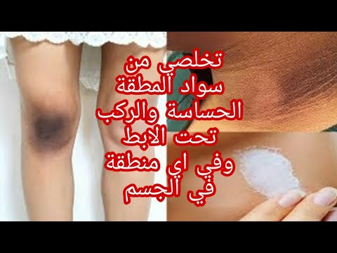 عالجي سواد المنطقة الحساسة حتى لو كان عندو عشرين عام بوصفة سهلة 