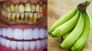 How to remove Dental plaque from teeth. How to whiten teeth at home