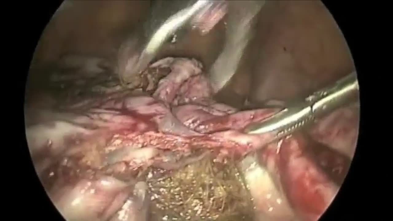 Ooforoplastia por video (cisto dermoide) / Video oophoroplasty (dermoid  cyst) 