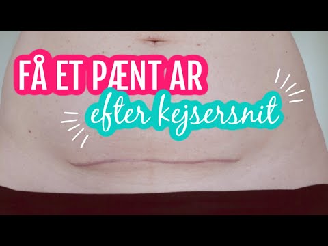 Video: Sådan Strammes Din Mave Efter En Kejsersnit