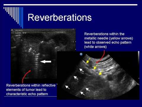 Physics of Ultrasound Image Artifacts Segment 3