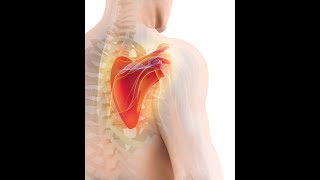 Fix your Shoulder. Scapular Winging Exercises | Life Rx Los Angeles