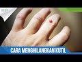 Hilangkan Kutil dengan cara ampuh ini !! / Go Dok Indonesia