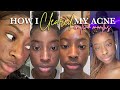 HOW I CLEARED MY SKIN IN LESS THAN TWO MONTHS FT ACNECIDE  *images included* | MSSANDYBABY