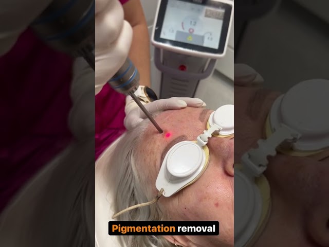 Pigmentation removal with Fotona laser | Newcastle Cosmetic Doctor | Patient first laser treatment class=