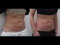 The Mummy Tummy Makeover at Dr Leah Cosmetic Skin Clinics