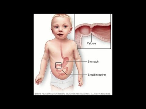 Video: Stenoza pilorică necesită întotdeauna o intervenție chirurgicală?