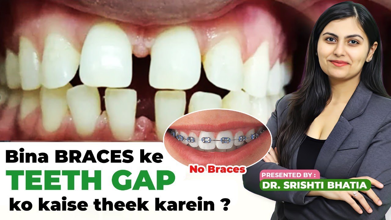 BINA BRACES ke TEETH GAP jaldi kaise theek kren? Dr. Srishti Bhatia 