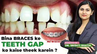 Bina Braces Ke Teeth Gap Jaldi Kaise Theek Kren? Dr. Srishti Bhatia