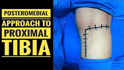 Prone Posteromedial Approach Tibial Plateau for Posteromedial and Posterolateral Condyle Plating