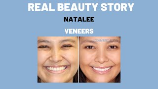 Real Beauty Story- Natalee, Veneers