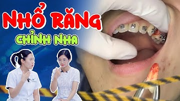 Niềng Răng Có Bắt Buộc Phải Nhổ Răng Không? Hậu Quả Khi Nhổ Răng "Vô Tội Vạ" | Lạc Việt Intech