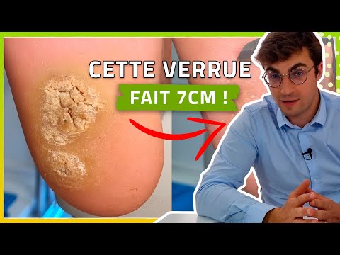 The BIGGEST WART (in the WORLD)? Treatment with Vercid