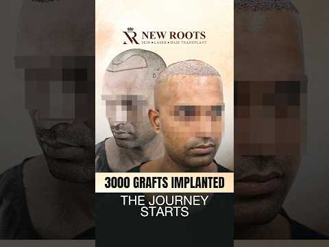 Hair Transplant in Siliguri: Grade 3 Baldness | 3000 Grafts #hairtransplant #siliguri #shorts