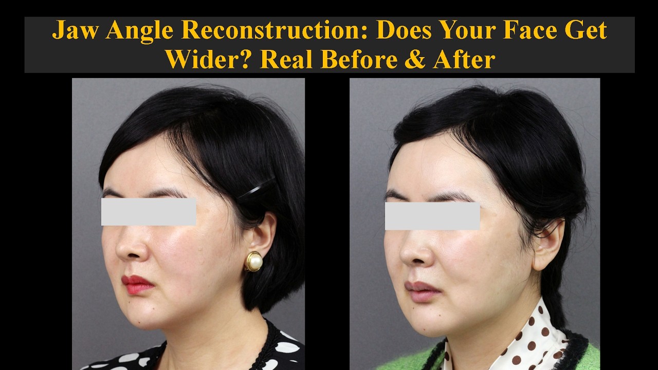 Jaw Angle Reconstruction: Does Your Face Get Wider? Real Before & After ...