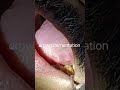 dentist#dentalprocedure#dentalprosthesis#zirconia#oralhealth#chewing #savetooth