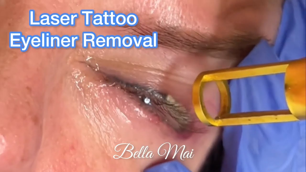 Tattoo Removal in Atlanta  Anna Burns Permanent Cosmetics
