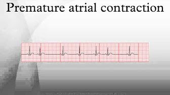 test heartbeat Popular & contraction ventricular Atrial Premature
