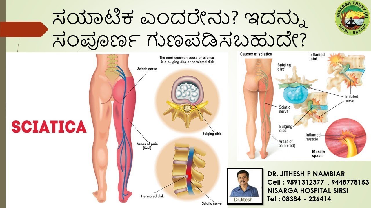 WHAT IS SCIATICA ? PART - II | CAN IT BE COMPLETELY CURED ?  | DR.JITHESH P NAMBIAR