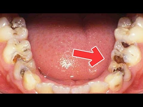 how-to-heal-tooth-decay-and-reverse-cavities-using-this-easy-remedy
