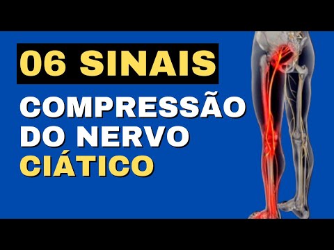 Vídeo: Como tratar um nervo comprimido (com fotos)