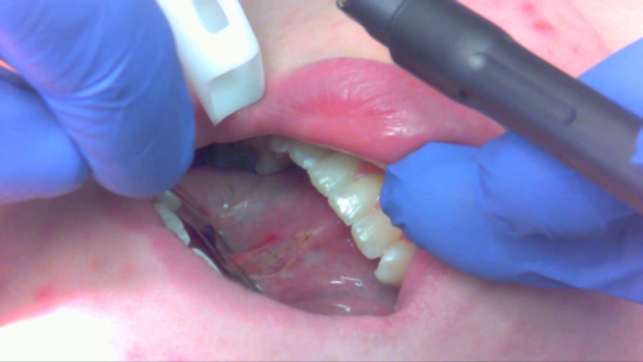 Adult Tongue Tie Release YouTube