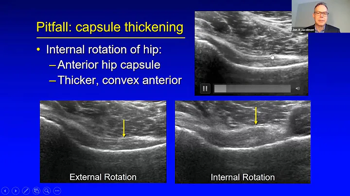 Dr. Jon Jacobson talks about US of Hip Pathology