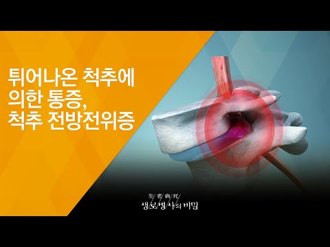 튀어나온 척추에 의한 통증, 척추 전방전위증 - (20180725_656회 방송) 허리 노화에 맞서라